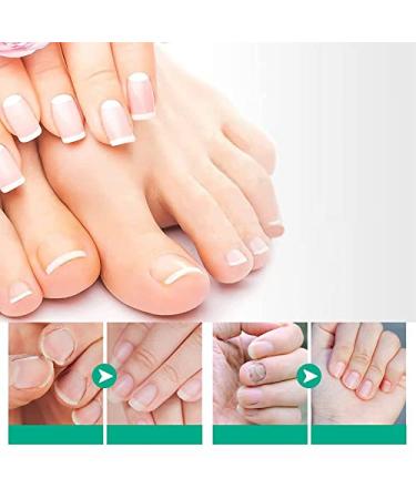 Kerassentials Toenail Treatment Extra Strength - Repair Damaged & Discolored Nails - 3PCS - Buy Online on GoSupps.com