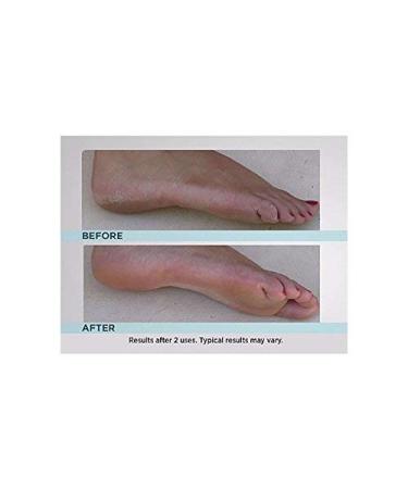 Emjoi Micro-Pedi Callus Remover - Smooth and Soft Feet in Minutes - Buy Online on GoSupps.com