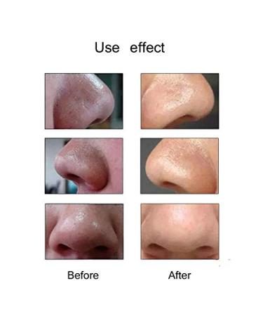 2021 Hot Microdermabrasion Pore Vacuum Cleanser Pen | Blackhead Removal Beauty Machine - Buy Online on GoSupps.com