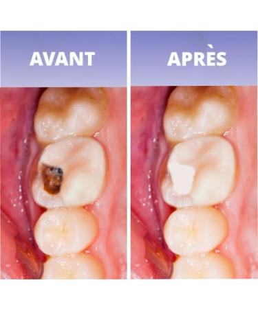 Lead Bath Tooth Plaster for Enhanced Retention | International Shipping Available - Buy Online on GoSupps.com