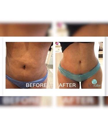 LIPOROLLER Muscle Roller Stick for Recovery - Ideal Post-Op Liposuction Supplies - Quality EVA Material with Ridges for Back, Leg, and Abdomen - Buy Online on GoSupps.com