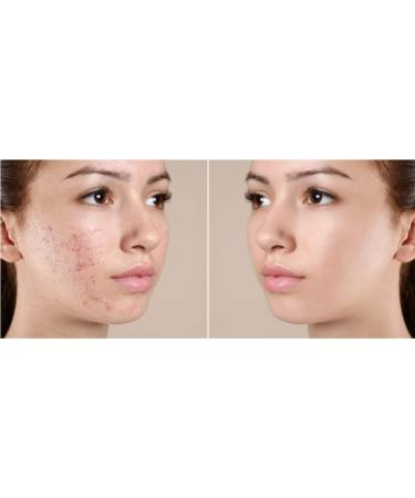 Avena Sulphur Soap & Avena Sulphur Cream Sulfur Ointment Skin Care For Acne Sulphur Ointment Sulfur Soap Large 200g Bar - Buy Online on GoSupps.com