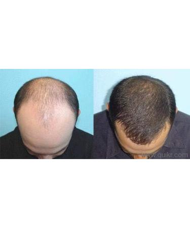 Onion Juice for Hair Care: Treatment of Alopecia Inflamed Dry or Itchy Scalp Hair Loss Dandruff Thinning Hair Dry or Brittle Hair  - Buy Online on GoSupps.com