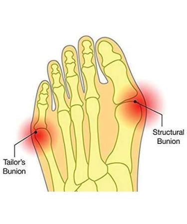 ERINSHOP Toe Separators - Big Toe Alignment Spacers for Bunions - Bunion Relief for Men and Women - 1 Pair White - Buy Online on GoSupps.com