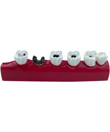 LEYTON Tooth Model for Dental Teaching | Caries Model Enhance Understanding of Pathological Processes | International Shipping Available - Buy Online on GoSupps.com