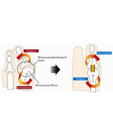 Hallux Valgus Aid - XL Bunion Corrector & Supporter | Bochikun Day & Night Pain Relief Splint (Left - Buy Online on GoSupps.com