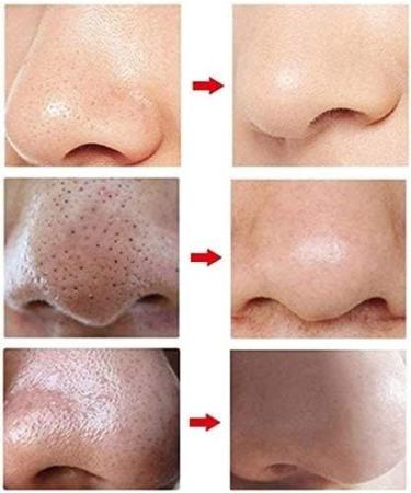 QINERSAW Blackhead Remover Pore Cleaner Blackheads Pore Sucker with 5 Suction Heads Acne Comedone Extractor Kit Blackhead Removal Tool for Beauty Salon (Color : Red) (Color : White) - Buy Online on GoSupps.com
