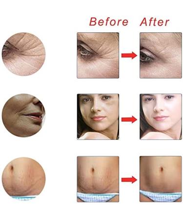 Dermaroller 2.0 mm | Titanium Microneedle for Face & Body | Boost Beard Growth & Reduce Hair Loss - International Shipping - Buy Online on GoSupps.com