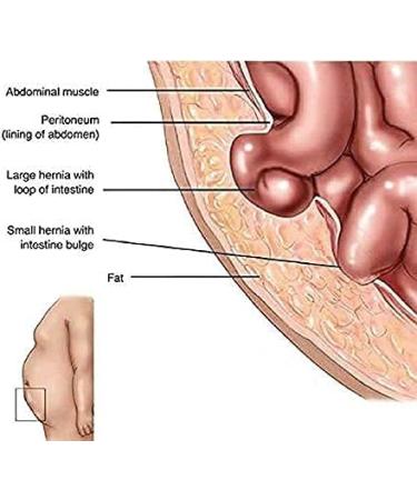 SOLACE CARE Hernia Belt Truss for Inguinal & Sports Hernia Support - Pain Relief & Recovery - Adjustable Straps - Medium (89-104 cm) - Buy Online on GoSupps.com