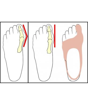 Buy Day Correction Hallux Valgus Left (S) - Effective Treatment for Bunion Relief | International Shipping - Buy Online on GoSupps.com
