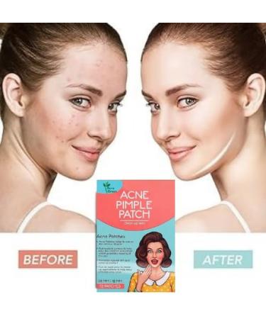 Buy Hydrocolloid Pimple Patches - 72 Fast-Acting Acne Spots Tea Tree Oil Waterproof & Invisible for Teens - Effective Breakout Healing Solutions - Buy Online on GoSupps.com