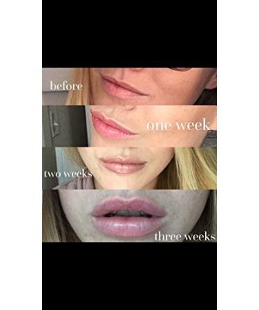 SeneDerm Solutions Lip Volumizer - Enhance Your Lips | Buy Internationally - Buy Online on GoSupps.com