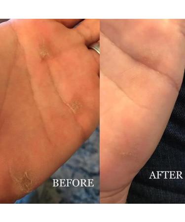 Callus Performance Ultimate Care Bundle | Callus Score Plus Healing Salve with 2 Callus Smoothers - Prevent, Repair, and Heal Callus Rips - Buy Online on GoSupps.com