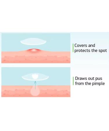 MTAR Tea Tree Oil Hydrocolloid Pimple Patches - Invisible Waterproof Acne Treatment for Skin Care - Buy Online on GoSupps.com