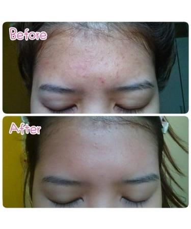 PROVAMED Acne Retinol-A Gel with Vitamin A-Retinol & Zinc PCA 10 g. for Comedone Acne Tighten Pores - Buy Online on GoSupps.com