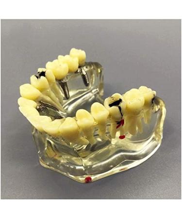Fhuili Teeth Implant Model - Removable Chewing Gum & Prosthesis - Half-Port Bridge Restoration for Study & Recovery - Buy Online on GoSupps.com