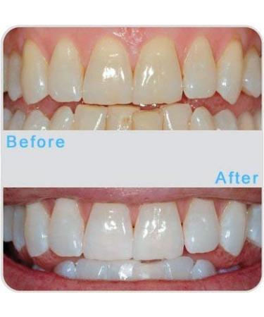 Custom Teeth Whitening Trays + 2 Syringes of Premium Gel | Dentist Quality | Made in USA - Buy Online on GoSupps.com