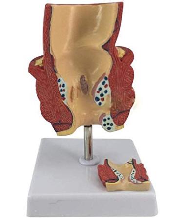 Pathological Hemorrhoids - Injury Model of Hemorrhoids Colorectal - Placed On Base - The Best Educational Support for Communication