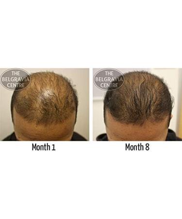 Onion Juice for Hair Care: Treatment of Alopecia Inflamed Dry or Itchy Scalp Hair Loss Dandruff Thinning Hair Dry or Brittle Hair  - Buy Online on GoSupps.com