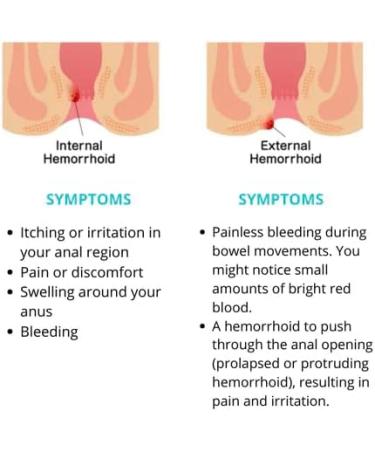 Heca Natural Herbal Hemorrhoid Capsules - Treatment & Relief for Women (5 Boxes) - Buy Online on GoSupps.com