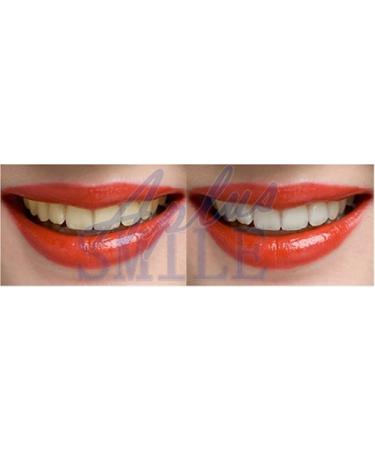 Instant White Smile 36% Carbamide Peroxide Teeth Whitening Gel - 20cc Syringes with Remineralization Gel - Buy Online on GoSupps.com