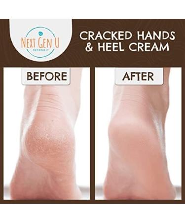 Next Gen U Hand & Heel Cream 250ml - Vegan Intensive Moisturizer for Very Dry Hands & Feet - Softens Hard Calluses, Natural Care for Sore Winter Heels - Men & Women - Buy Online on GoSupps.com