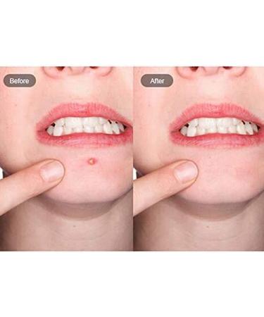 Acne Patches | Hydrocolloid Spot Repair for Pimples & Blemishes | Master Patch - Targeted Protection (Beige) - Buy Online on GoSupps.com