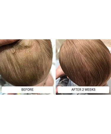 Happy Cappy Sensitive Skin Bundle - Cradle Cap & Seborrheic Dermatitis Relief for All Ages - Buy Online on GoSupps.com