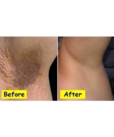 Whitening Cream for Face, Armpits, Neck, and Bikini Area - 1.77FL.Oz - Buy Online on GoSupps.com