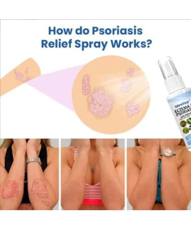 Meellop Herbal Psoriasis, Eczema, Vitiligo Relief Spray - Skin Repair, Stop Burning & Itching (5Pcs) - Buy Online on GoSupps.com