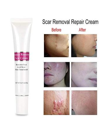 Scar Removal Cream | Anti-Scar Gel for Old Scars, Stretch Marks & Burned Skin Repair - Buy Online on GoSupps.com