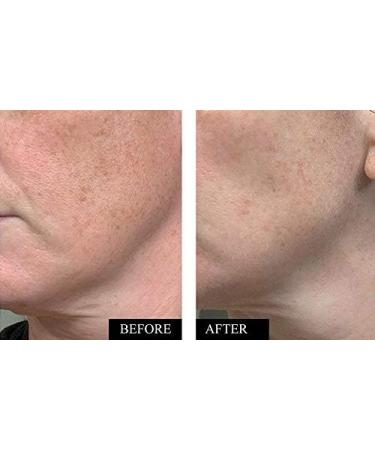  Kleem Organics Set of 2 Vitamin C 20% Face Serums 30ml with Hyaluronic Acid and Vitamin E Anti-Aging Anti-Wrinkle Anti-Dark Spot Moisturizing and Brightening Natural Care for All Skin Types - Buy Online on GoSupps.com