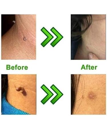 Micro Skin Tag Remover Device - Skin Tag Removal Kit Remove Small to Medium Skin Tags with Extra Bands - Buy Online on GoSupps.com