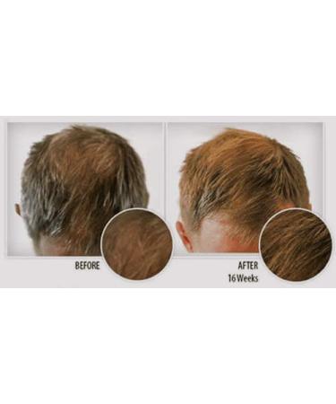 PROPIDEX Premium Hair Regrowth Treatment for Men & Women | Biotin & Saw Palmetto Formula to Prevent Hair Loss & Stimulate Follicles - Buy Online on GoSupps.com