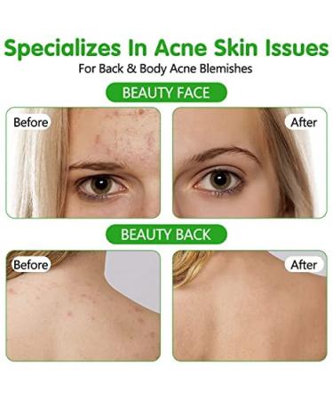 Best Acne Treatment Spray with Organic Tea Tree Oil - Clear Acne on Face Body & Back | 4.3 OZ Skin Care Solution - Buy Online on GoSupps.com