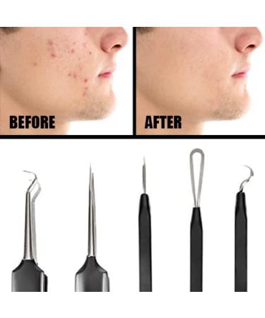 Pete & Pedro Acne & Blackhead Remover Tool Set - 5 Piece Pimple Popper Kit + Mirror | For Men & Women | Removes Whiteheads, Zits, Blackheads, Comedones | Seen on Shark Tank - Buy Online on GoSupps.com