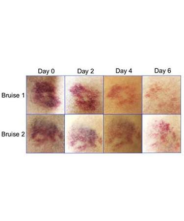 BruiseGONE - Fast-Acting Natural Bruise Remedy | Heal Bruises One Week Quicker | Essential Oil Blend | Easy to Use & Absorb - Buy Online on GoSupps.com