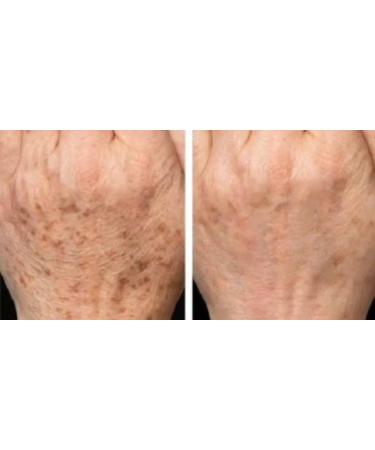 Effective Skin Care Solutions: Cure Acne Psoriasis Sunspots & Scars Shop Internationally - Buy Online on GoSupps.com