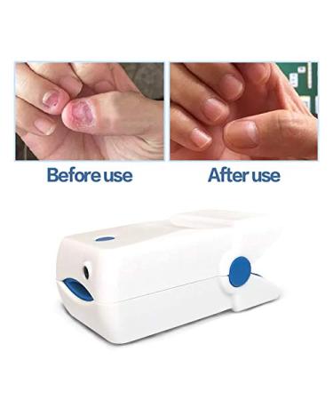 Fungus Treatment Laser Device - Home Use Nail-Fungus Remover - Buy Online on GoSupps.com