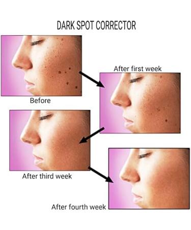 Nitada Dark Spot Corrector Serum (30ml) - Specialty Skincare to Reduce and Eliminate Dark Spots and Acne Scars Professional Grade Skin Brightening Serum Suitable For All Skin Types - Buy Online on GoSupps.com