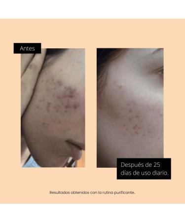 MI REBOTICA | Organic Sulfur Soap | Acne Treatment | Facial Soap for Oily and Acne Prone Skin | Powerful Anti-Acne Cleanser | - Buy Online on GoSupps.com