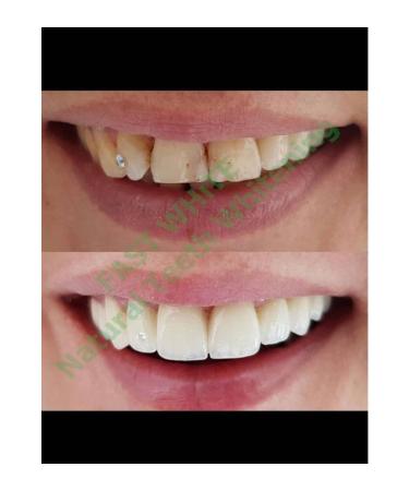 FAST WHITE NATURAL TEETH WHITENING Economical 10 Ml Teeth Whitening and Tartar Cleaning - Buy Online on GoSupps.com