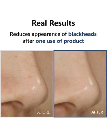 ISNTREE Hyper Acid 4 Serum 20ml | AHA BHA PHA LAH | Gentle Wash-off Chemical Exfoliant | Korean Skincare - Shop Internationally - Buy Online on GoSupps.com