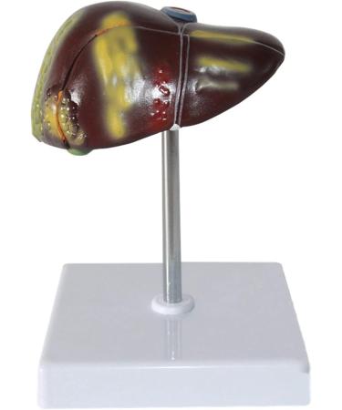 Liver Anatomy Model Human Liver Disease Model Liver Fat/Cirrhosis/Pathological Hepatobiliary Disease Model Medical Education and Training Auxiliary Human Organ Anatomical Model - Buy Online on GoSupps.com