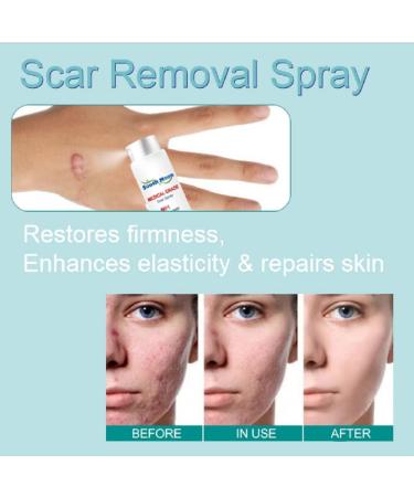 Medical Grade Scar Spray for All Types of Scars - Acne Scar Treatment for Face - Dark Spot Remover - Gentle Skincare for Acne Prone Skin (3 Pcs) - Buy Online on GoSupps.com