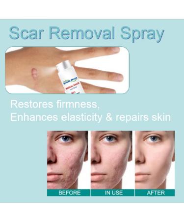 Advanced Scar Removal Spray for All Types of Scars - Acne Treatment for Face & Dark Spot Remover - Gentle Skin Care Formula - Buy Online on GoSupps.com