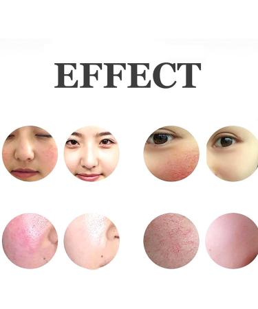 Varicose Veins Treatment Device 4 Adjustable Speeds Remove Red Spots from Blood Vessels of Facial Veins High Frequency Red Hair Reduction System for Salon - Buy Online on GoSupps.com