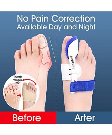 Bunion Corrector & Toe Separators - Heasoy Bunion Pain Relief Splints for Hallux Valgus, Overlapping Toe, Turf Toe - 2 Pair, 0% BPA - Buy Online on GoSupps.com