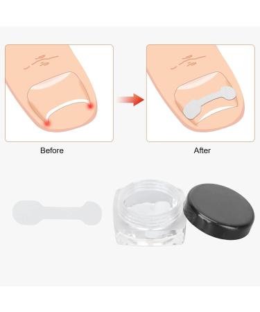 10 Pcs Painless Ingrown Toenail Correction Strips - Fix Paronychia Fast | International Shipping Available - Buy Online on GoSupps.com