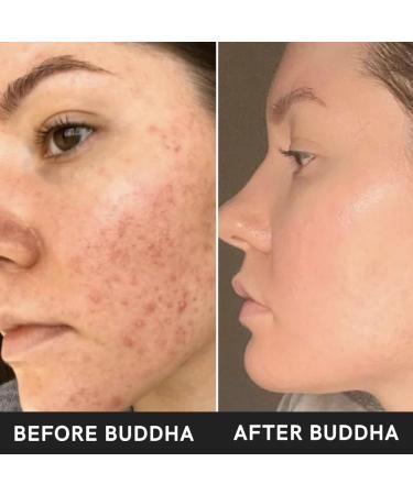 Buy Chemical-Free Acne Ubtan (50g) - Exfoliate Pimples & Rough Skin with Premium Clays | International Shipping - Buy Online on GoSupps.com